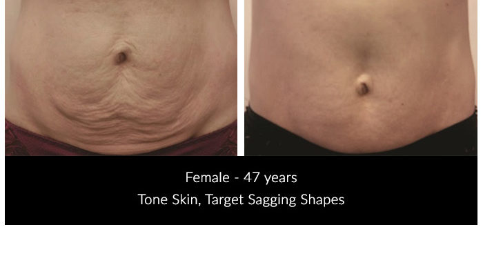 endermologie® Better Than CoolSculpting