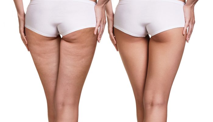 Female buttocks before and after cellulite