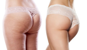 treating cellulite